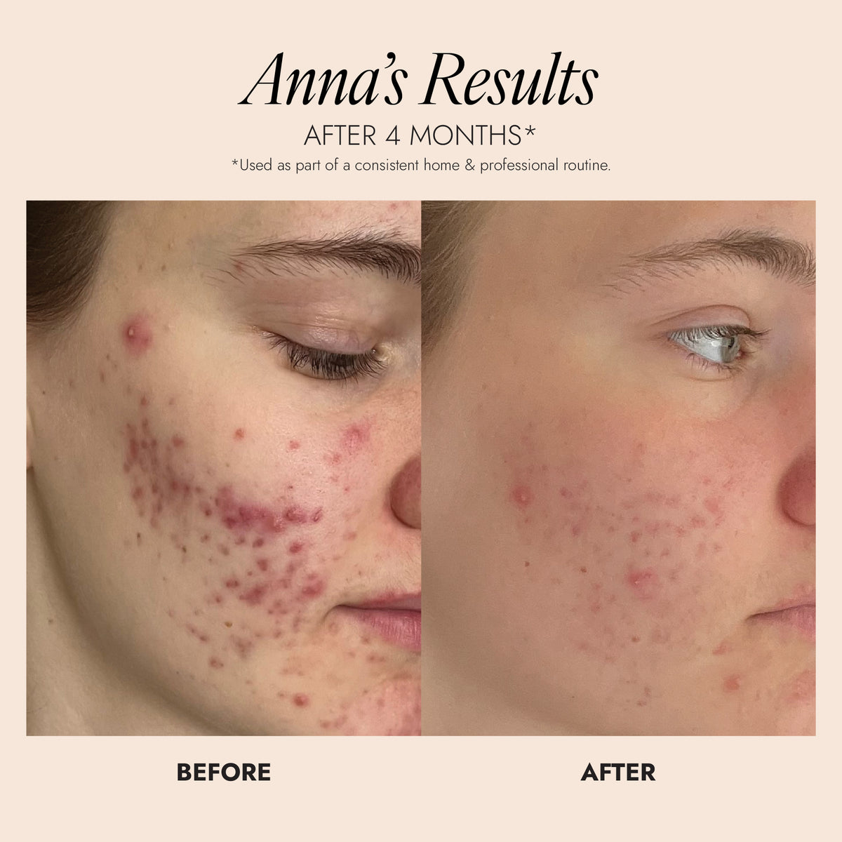 Before and after image showing a visible improvement in acne skin following using of the Purifying Cleanser