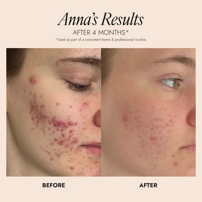 Before and after image showing a visible improvement in acne skin following using of the Purifying Cleanser
