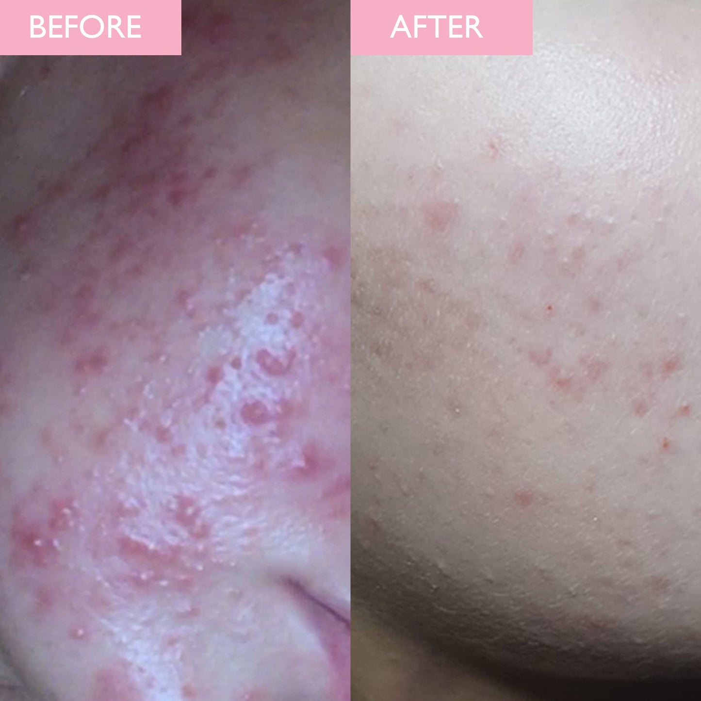 Before and After image showing a dramatic improvement in red infammed acne.  Skin appears calmed, smoother and with less red spots.