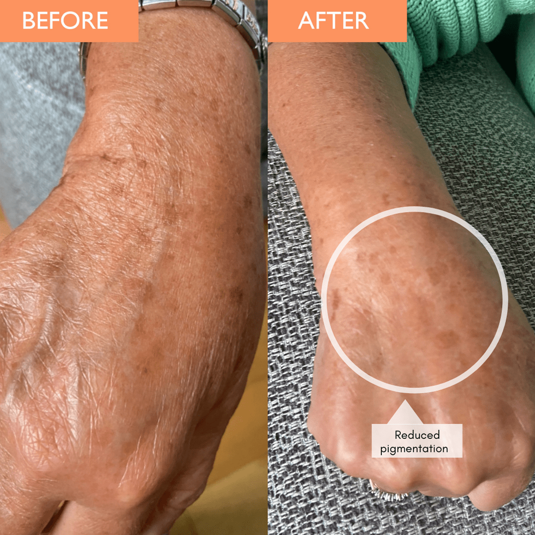 Anti-ageing vitamin c serum before and after photos on a womens hand after use.  Reduced pigmentation is shown in the form of reduced colouring from brown age spots.