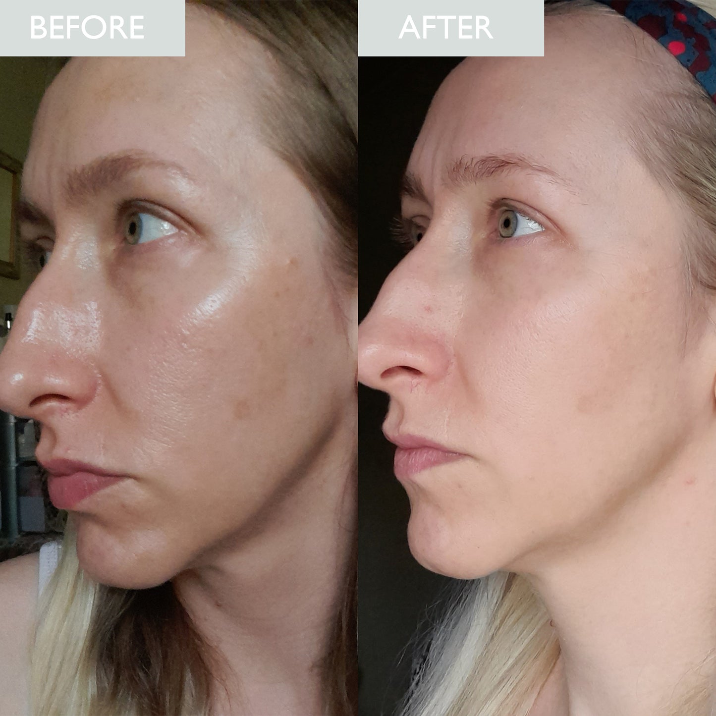 Before and after results of a lady with oily skin using the purifying daily moisturiser with SPF 30
