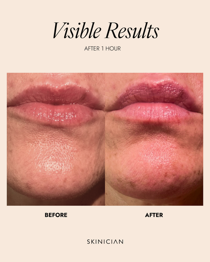 Before and after comparison of a person's lower face showing a subtle lip plump after one hour, with the text 'Visible Results AFTER 1 HOUR' and 'SKINICIAN' on a beige background.