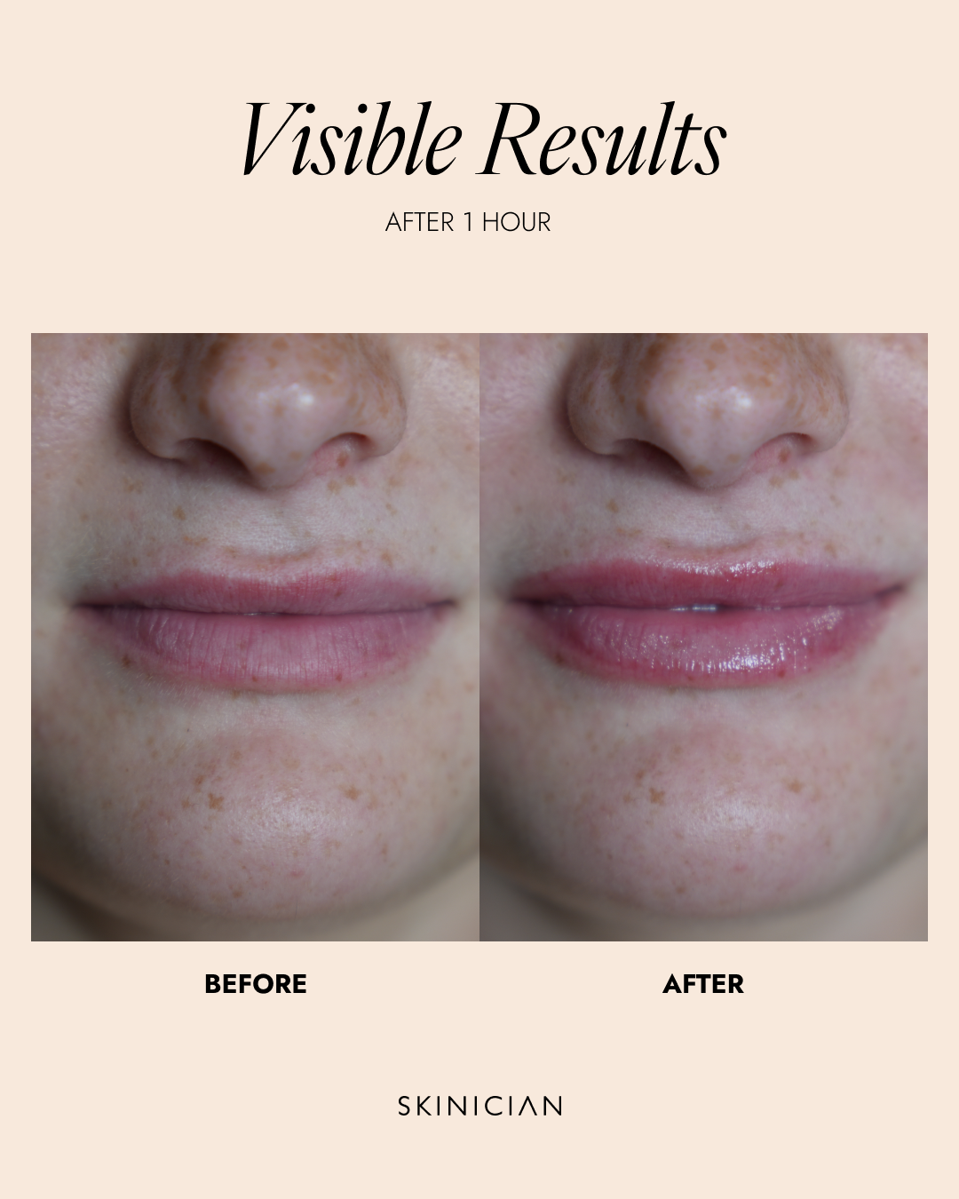 Before and after comparison of lips showing visible hydration and color improvement after one hour, with the text 'Visible Results AFTER 1 HOUR' and 'SKINICIAN' on a beige background.