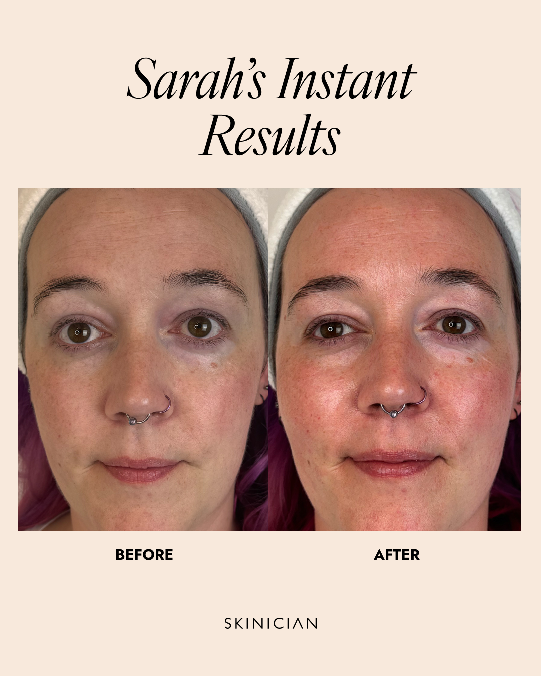 Before and after skin treatment comparison with 'Sarah's Instant Results' text.