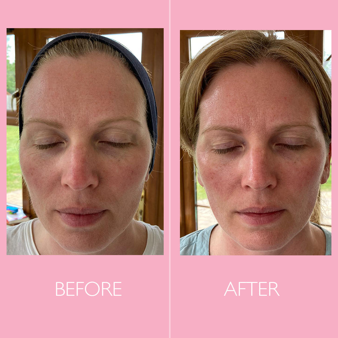 Before and after using the SPF30 face moisturiser for sensitive and dry skin types.