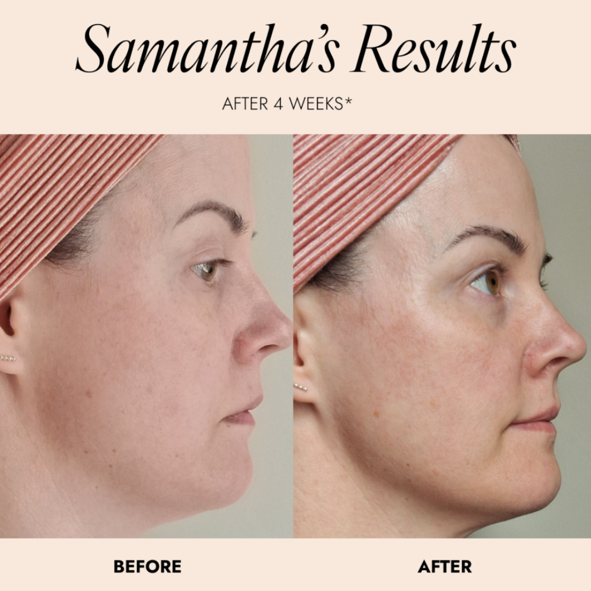 Before-and-after facial comparison of a woman showing an improvement in dull skin. Image reads 'Samantha's Results' at the top and 'BEFORE' and 'AFTER' labels at the bottom.