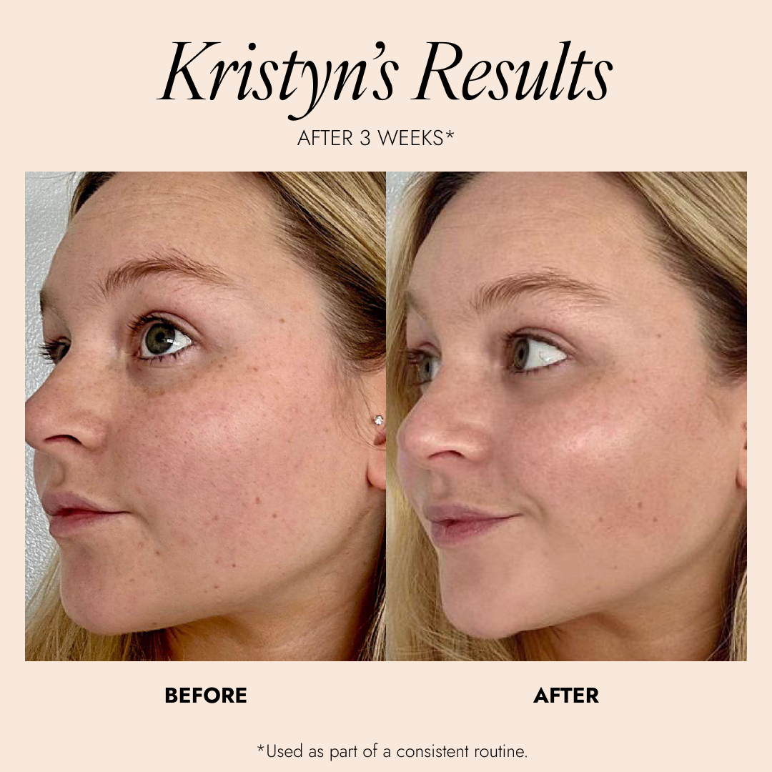 Before and after skin comparison of a woman, labeled 'Kristyn's Results'. The after shows plump, glowing skin.