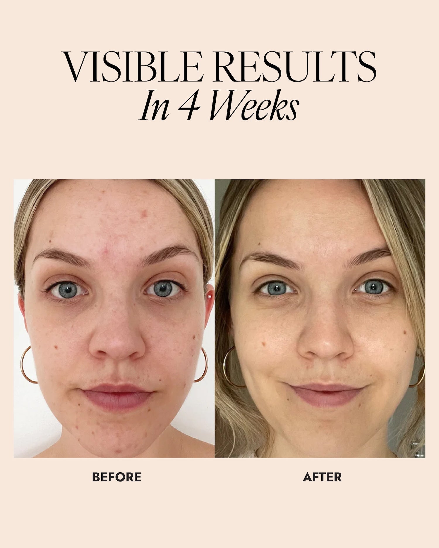 Image of a woman before and after using the combination skincare set. Improved skin tone, texture and breakouts can be seen after 4 weeks.
