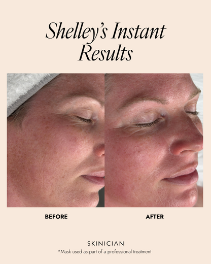 Before and after comparison of a person's face with text indicating 'Shelley's Instant Results' and 'Skinician'.