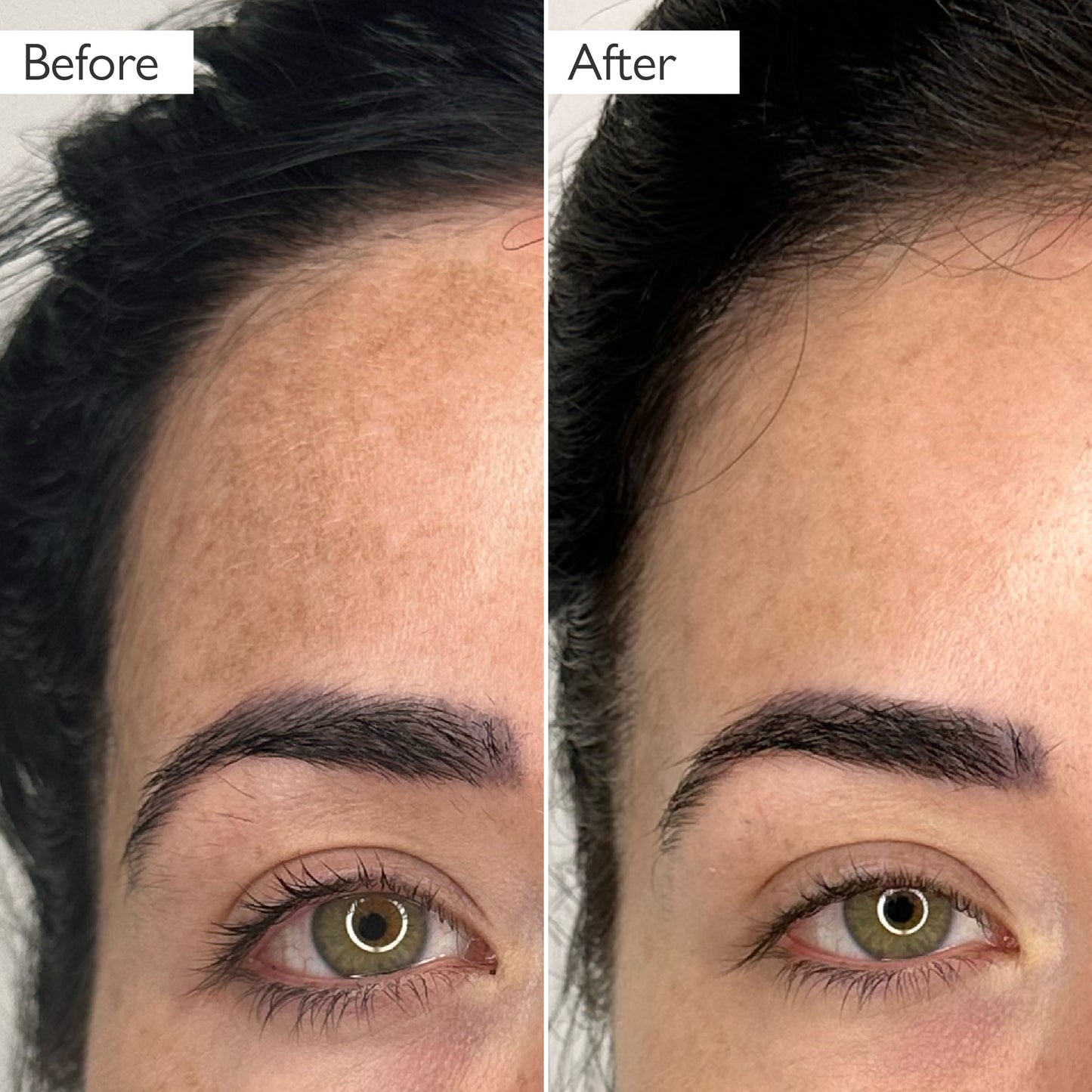 before and after image of woman's skin showing a reduction in skin pigmentation