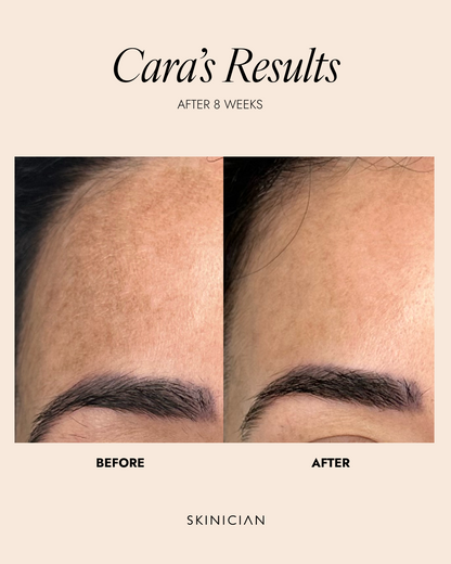 Before and after comparison of skin treatment results on a person's face, labeled 'Cara's Results' after 8 weeks by a skinician.