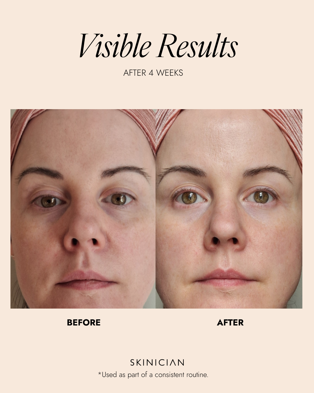 Before and after comparison of a woman's face with text indicating visible results after 4 weeks from a skinician.