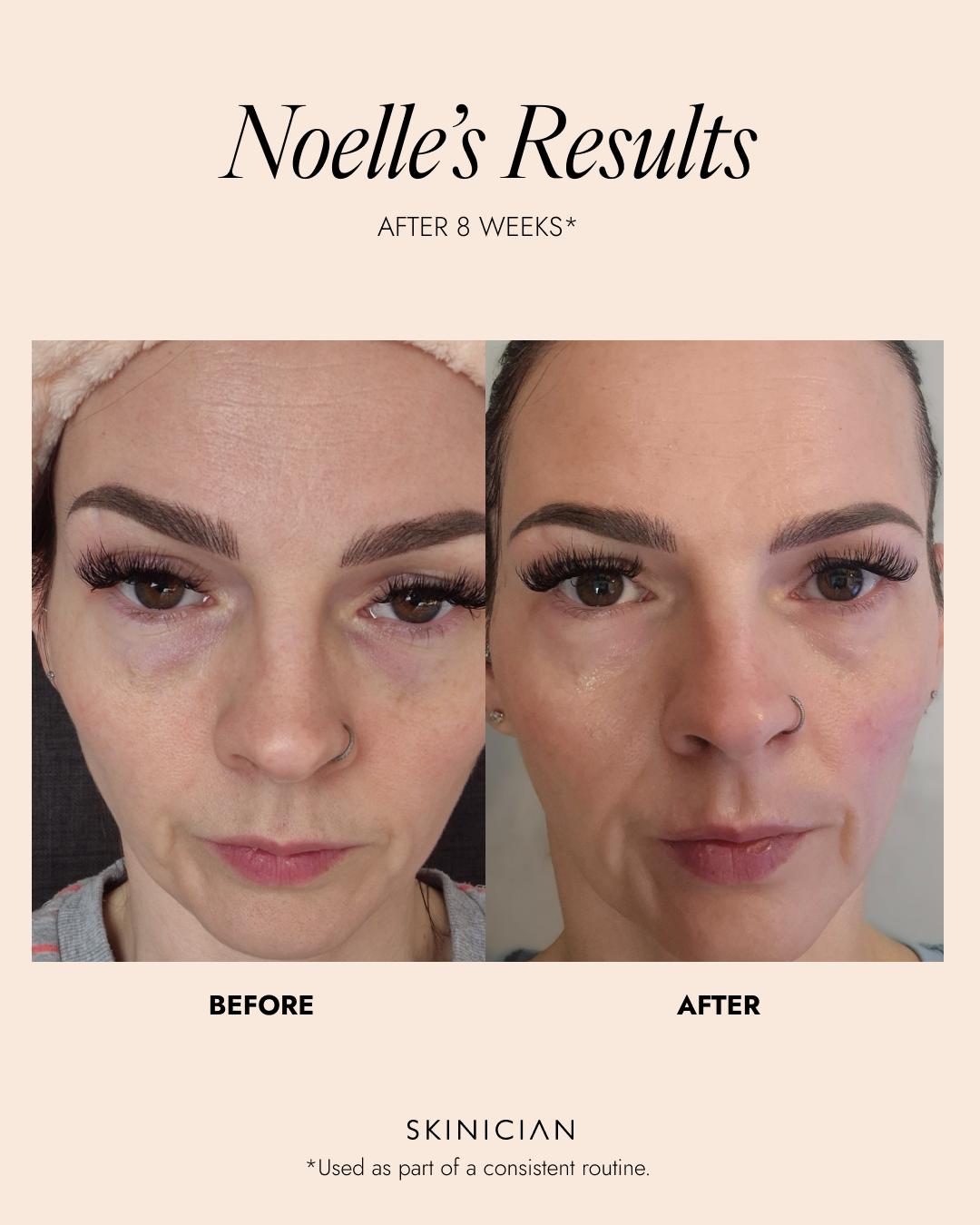 Before and after comparison of a woman's face with text indicating 'Noelle's Results' after 8 weeks of skin care routine.