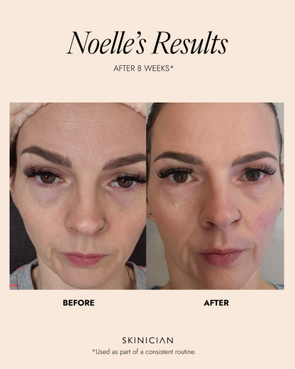 Before and after comparison of a woman's face with text indicating 'Noelle's Results' after 8 weeks of skin care routine.