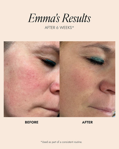 Before and after comparison of a woman's face with text indicating results after 6 weeks. Results show a reduction in skin redness and irritation.