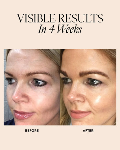 Before and after image of woman showing a reduction in forehead lines in 4 weeks.