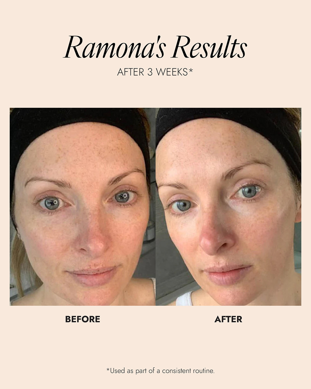 Before and after image following 3 weeks use of Pro-Radiance Enzyme Peel. Results show a noticeable difference in skin glow