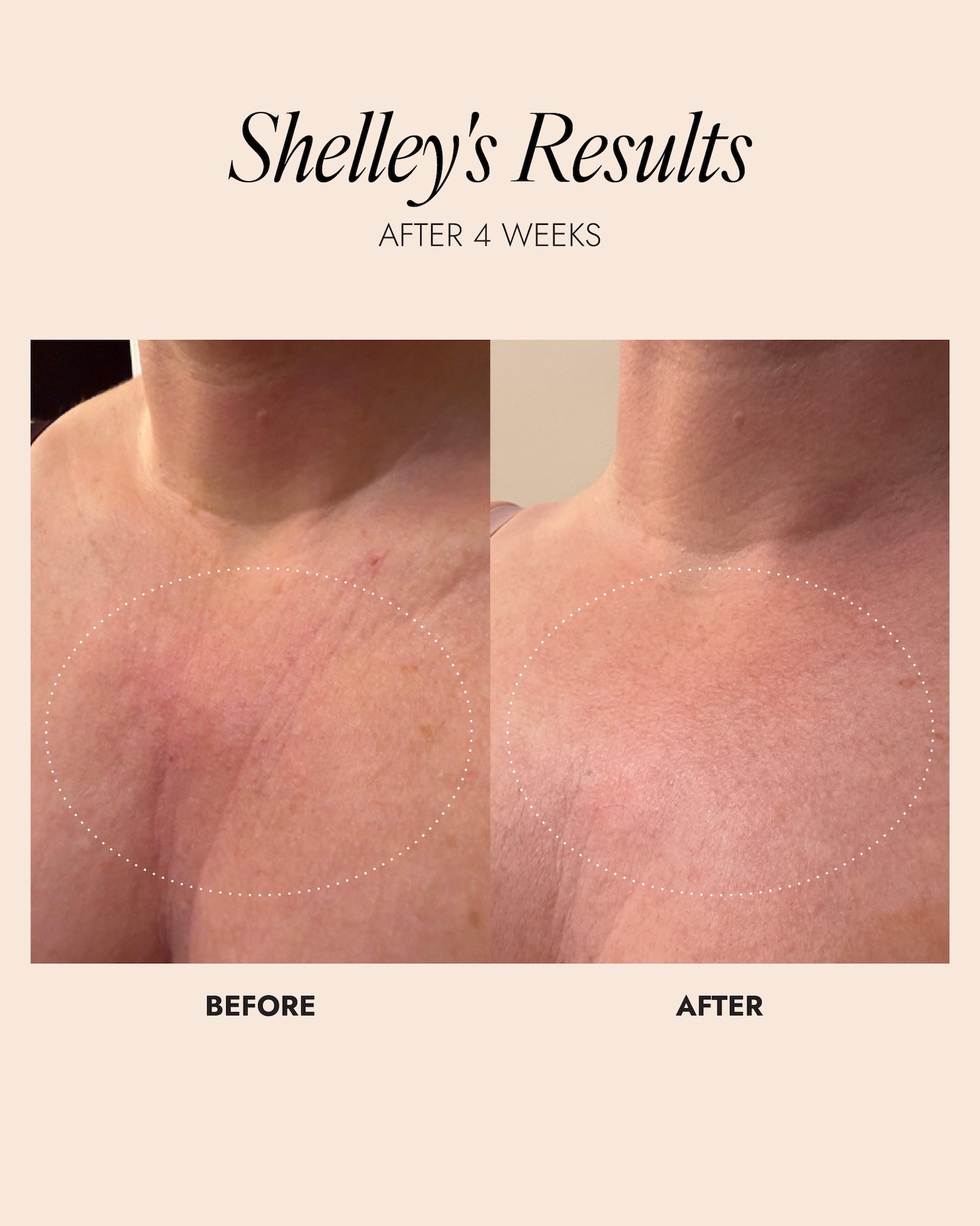 Image showing before and after of chest area. After 4 weeks there is a reduction in lines on the chest.