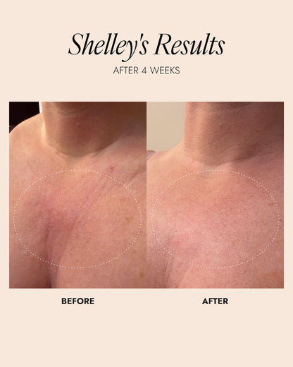 Image showing before and after of chest area. After 4 weeks there is a reduction in lines on the chest.