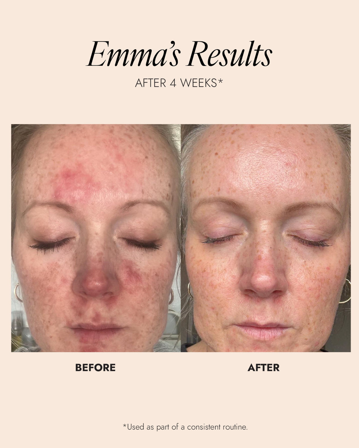 Before and after comparison of a woman's face with text indicating results after 4 weeks.