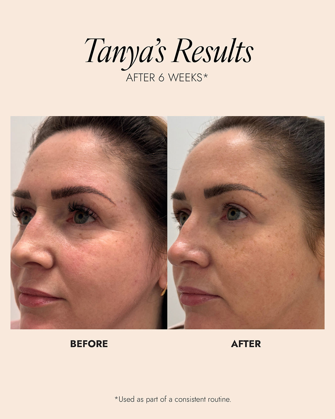 Before and after comparison of a woman's face with text indicating Tanya's results after 6 weeks. Results show a reduction in skin redness and an increase in evenness of skin.