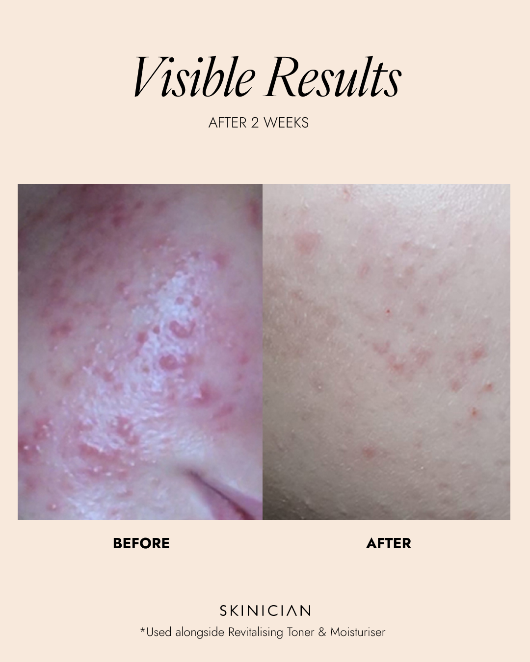 Before and after skin comparison showing visible results after 2 weeks of using a skincare product.