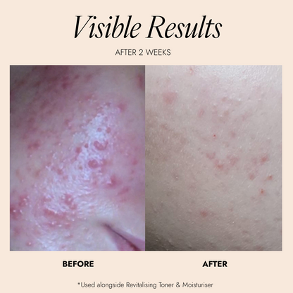 Before and after comparison showing skin results after 2 weeks of use, with visible reduction in redness and blemishes on a beige background with the text 'Visible Results'.
