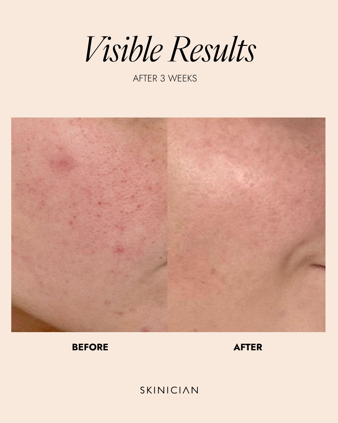 Before and after skin comparison showing visible results after 3 weeks with 'Skinician' branding.