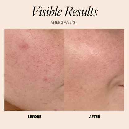 Before and after skin comparison showing visible results after 3 weeks with 'Skinician' branding.