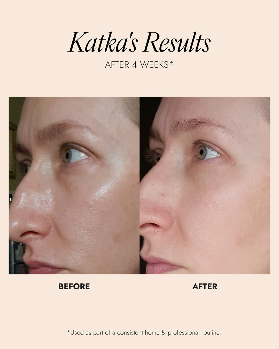 Before and after comparison of a person's skin with text indicating results after 4 weeks. Image shows a noticeable reduction in oily skin. 