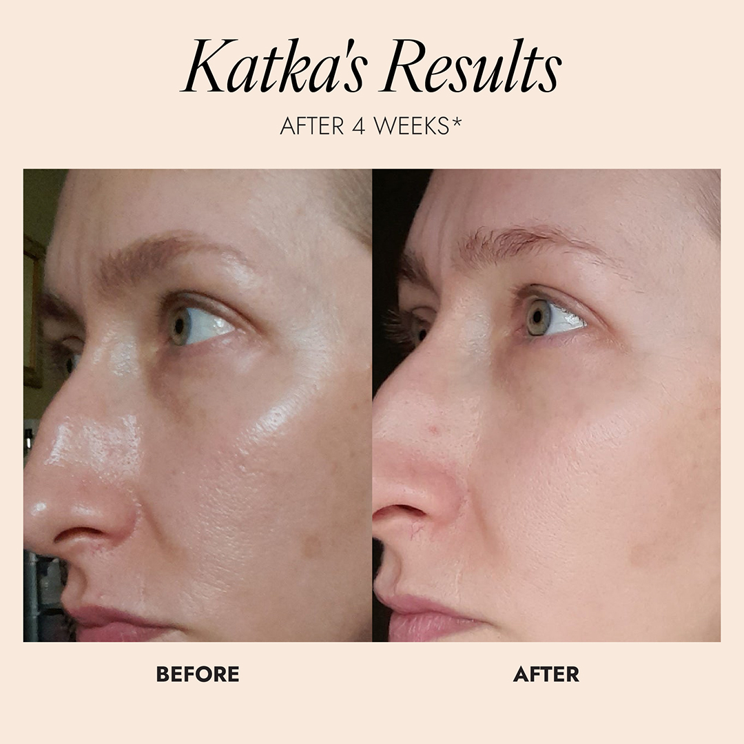 Before and after comparison of a person's skin with text indicating results after 4 weeks. Image shows a noticeable reduction in oily skin. 