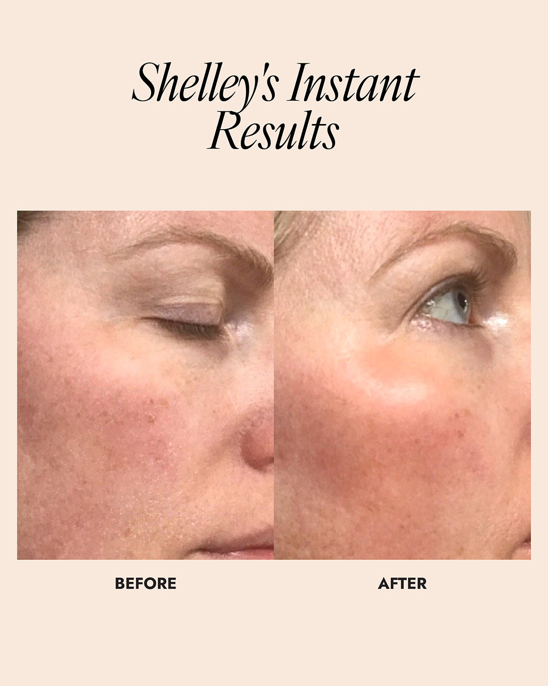 Before and after comparison of a person's eye area with text 'Shelley's Instant Results'.