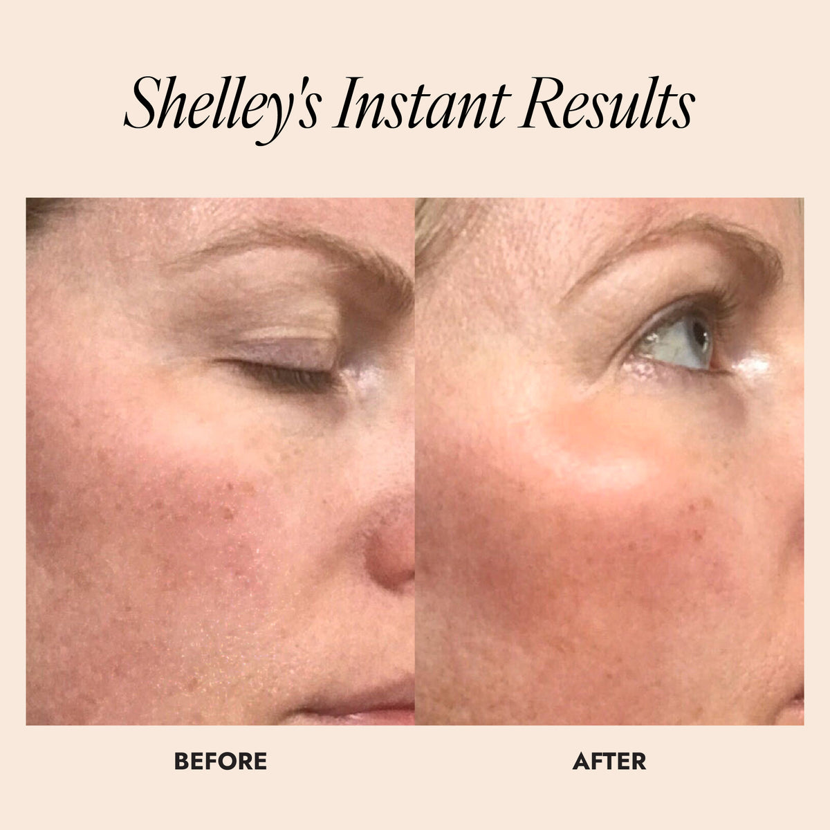 Before and after results of womans skin showing an improvement in skin luminosity. Text reads "Shelley's instant results"