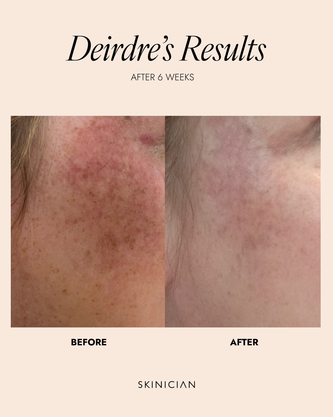 Before and after showing results following use of the Skinician Vitamin C Elixir. Image shows an improvement in skin pigmentation.