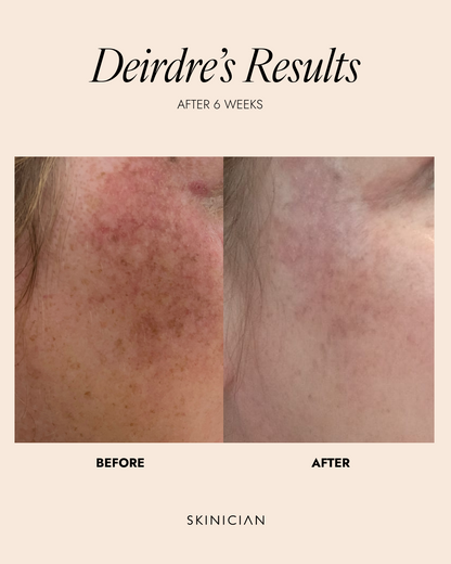 Before and after showing results following use of the Skinician Vitamin C Elixir. Image shows an improvement in skin pigmentation.