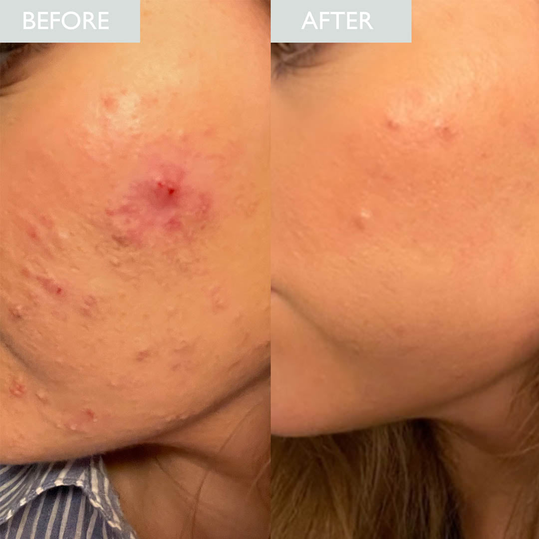 Before and after of a women with acne. Inflammed acne spots are cleared after using retinol powerbalm