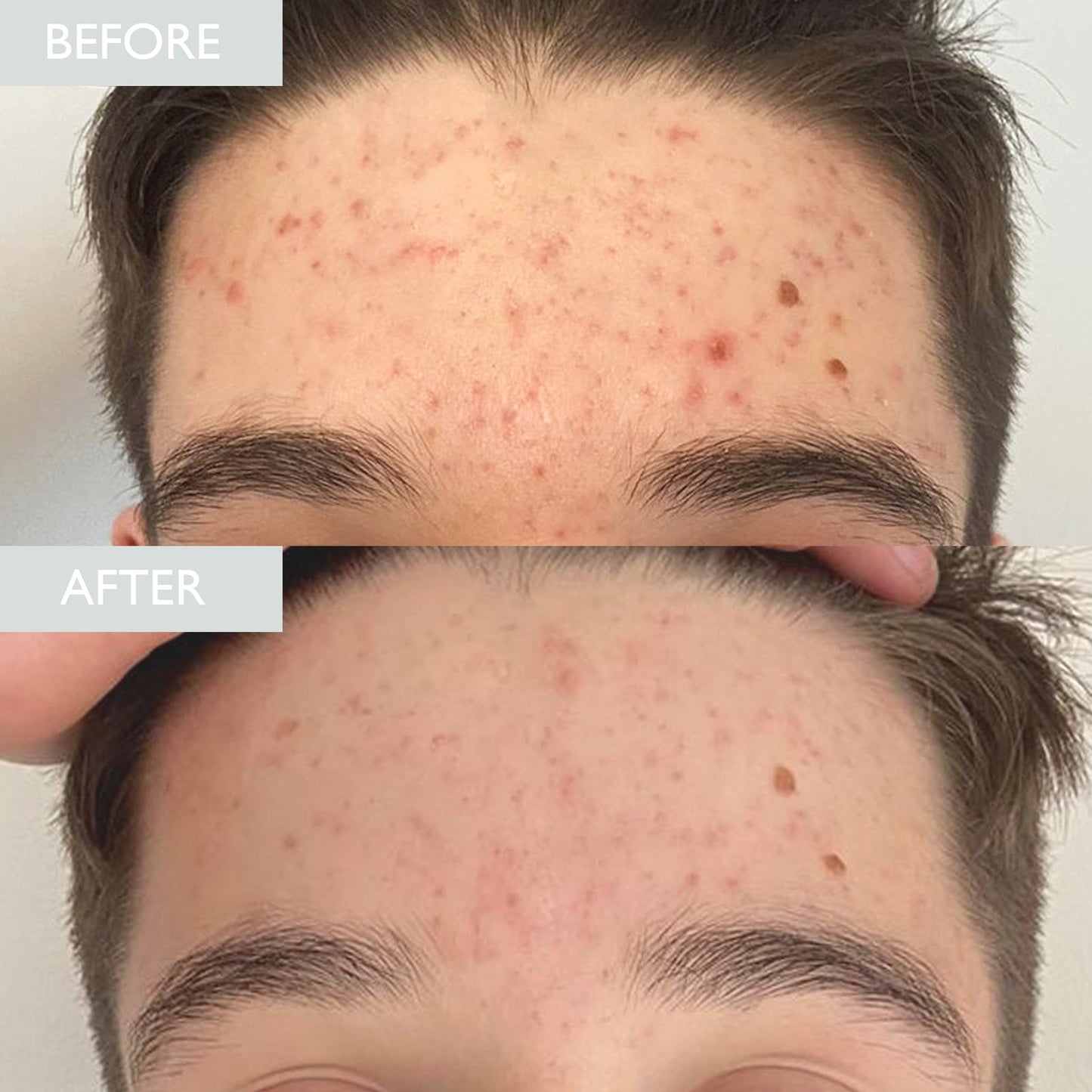 Before and after shown with improvement is spots and breakouts from acne, after using Skinician's oily skincare samples