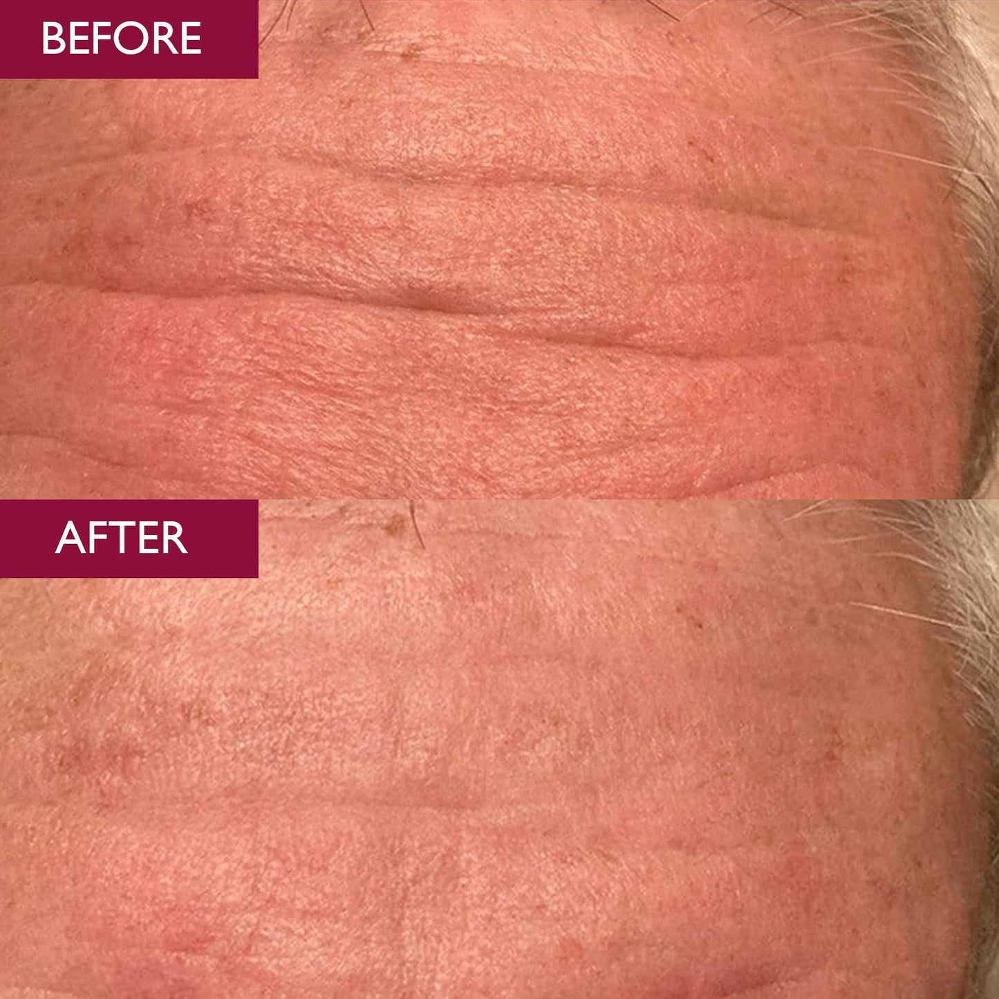 A before and after image of a man's wrinkles - results shown from using Skinicians facial serum for ageing