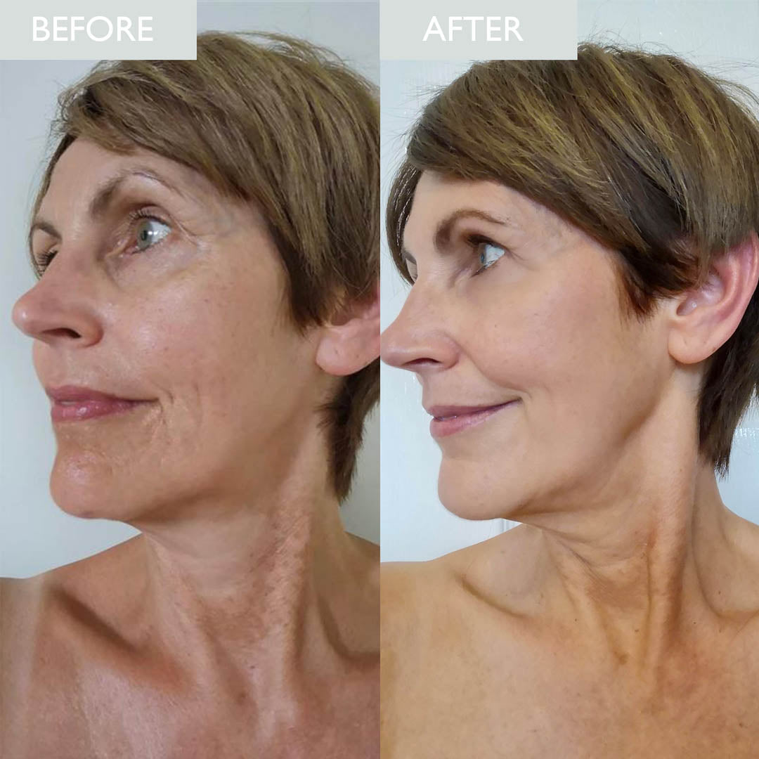 A before and after picture of a lady who has used SKINICIAN skin firming serum for the face within her routine.  Visible improvements can be seen.