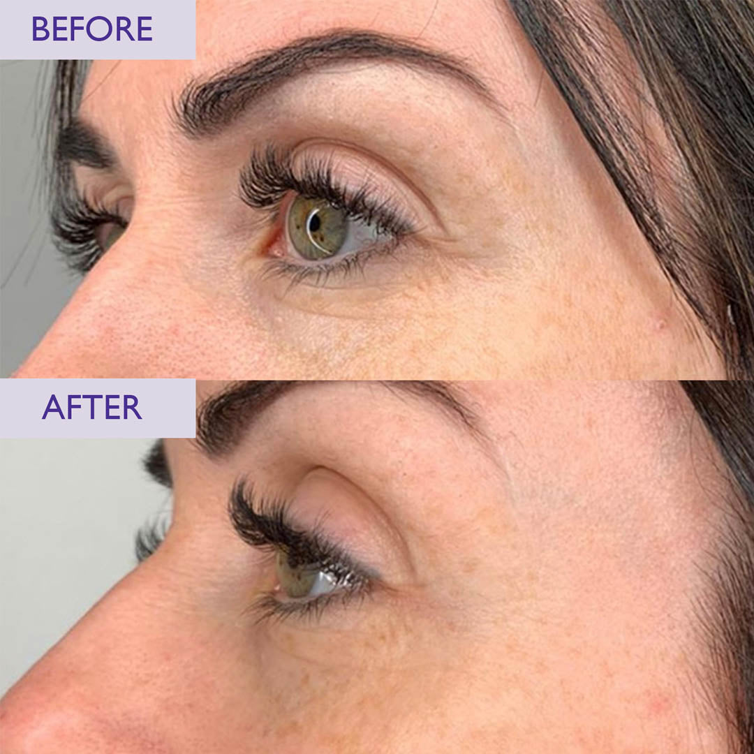 SKINICIAN Peptide Eye serum before and after image. Improvement in ageing seen around the eye area