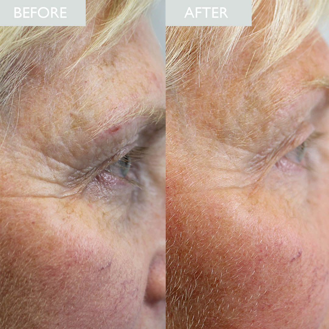 SKINICIAN Peptide Eye cream before and after image, showing fine line improvement around the eye area after use