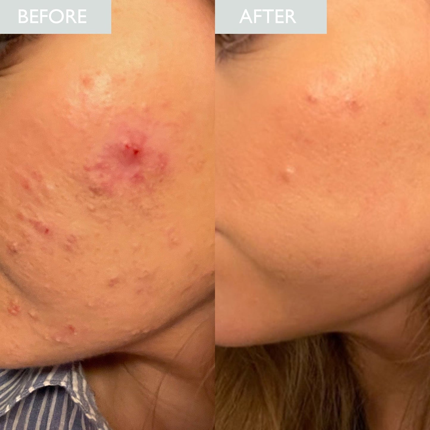 SKINICIAN Calming Serum Before and After picture on a lady with acne on her cheeks.  Clear and improved skin redness is shown
