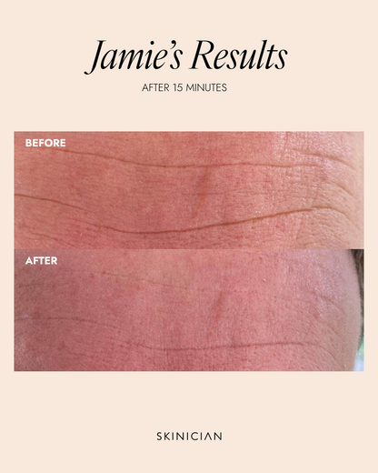 Before and after comparison of forehead showing a reduction in forehead lines in 15 minutes