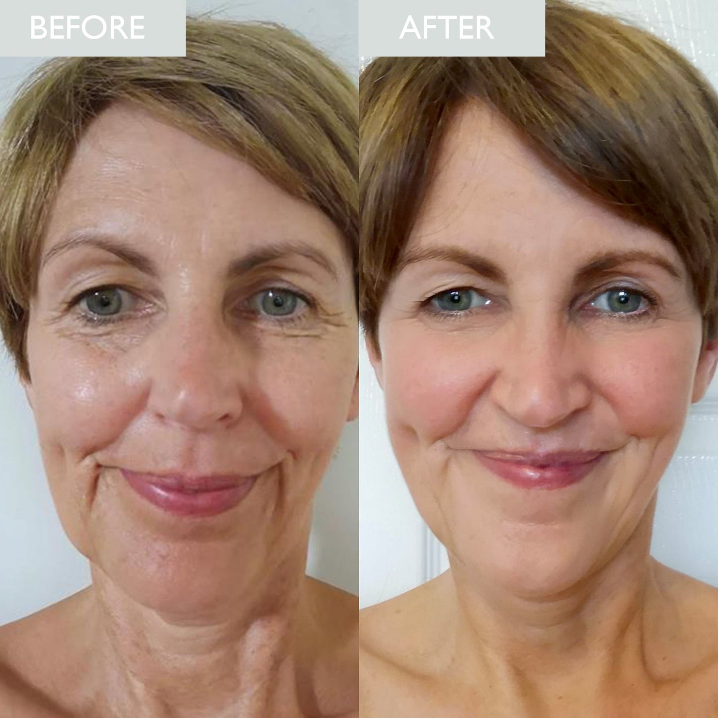 Before and after showing an overall improvement in skin ageing 