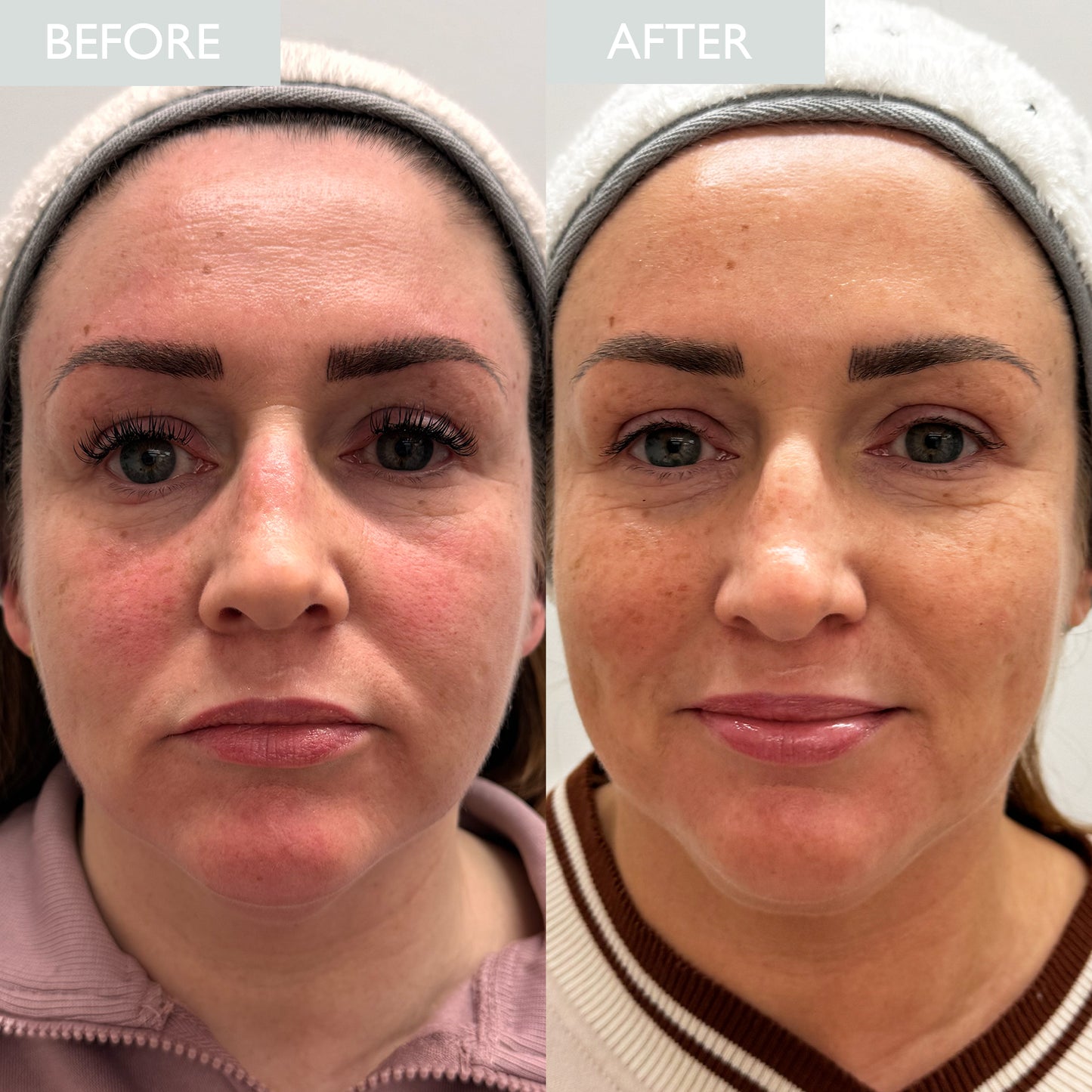 Before and after comparison of a woman's face showing a reduction in skin redness