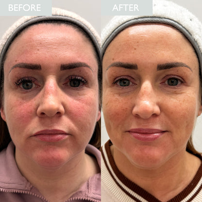 Before and after comparison of a woman's face showing a reduction in skin redness