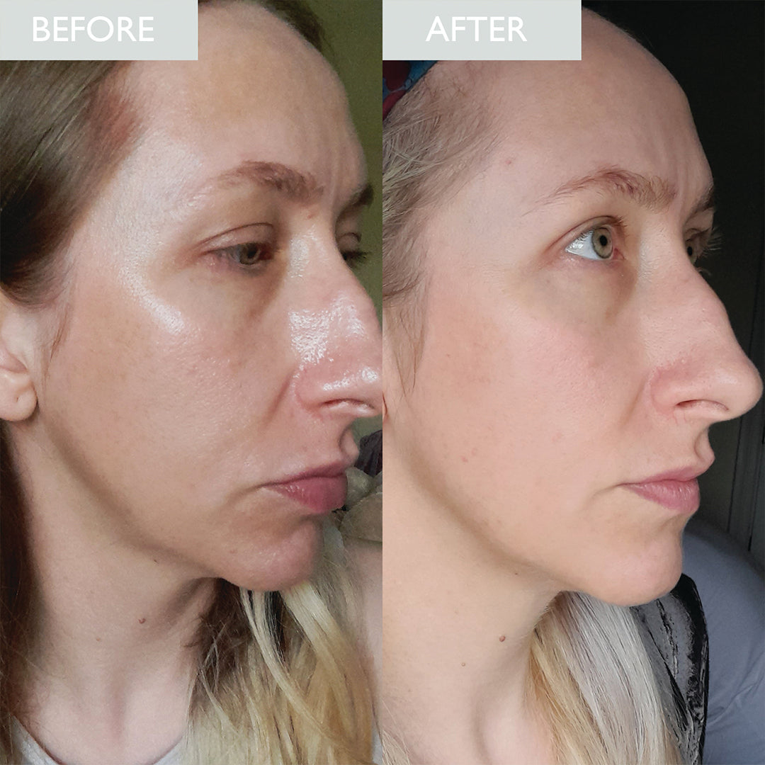 Reduced oilness before and after image from using skinician's purifying toner.