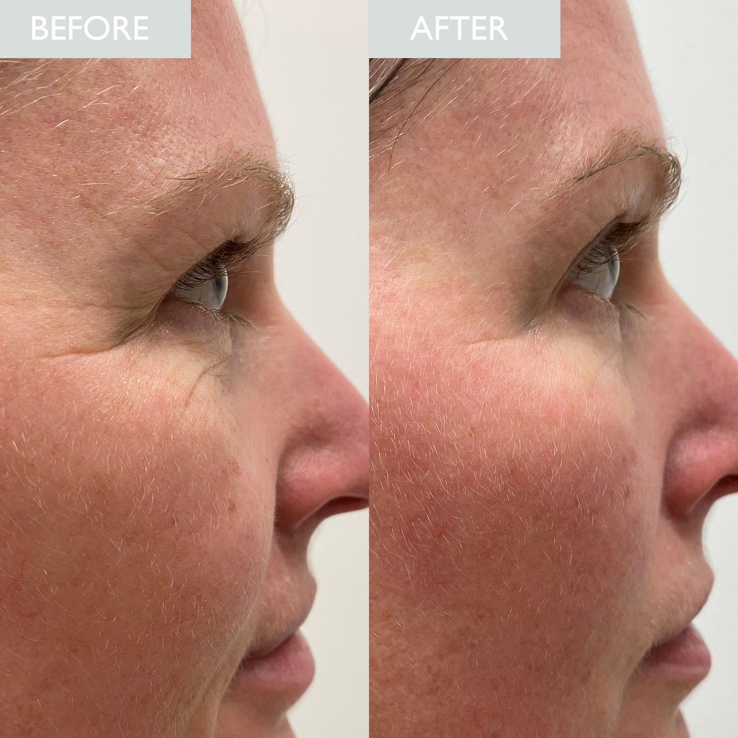 An image of a woman showing before and after - demonstrating a reduction in lines and darkness around eye area