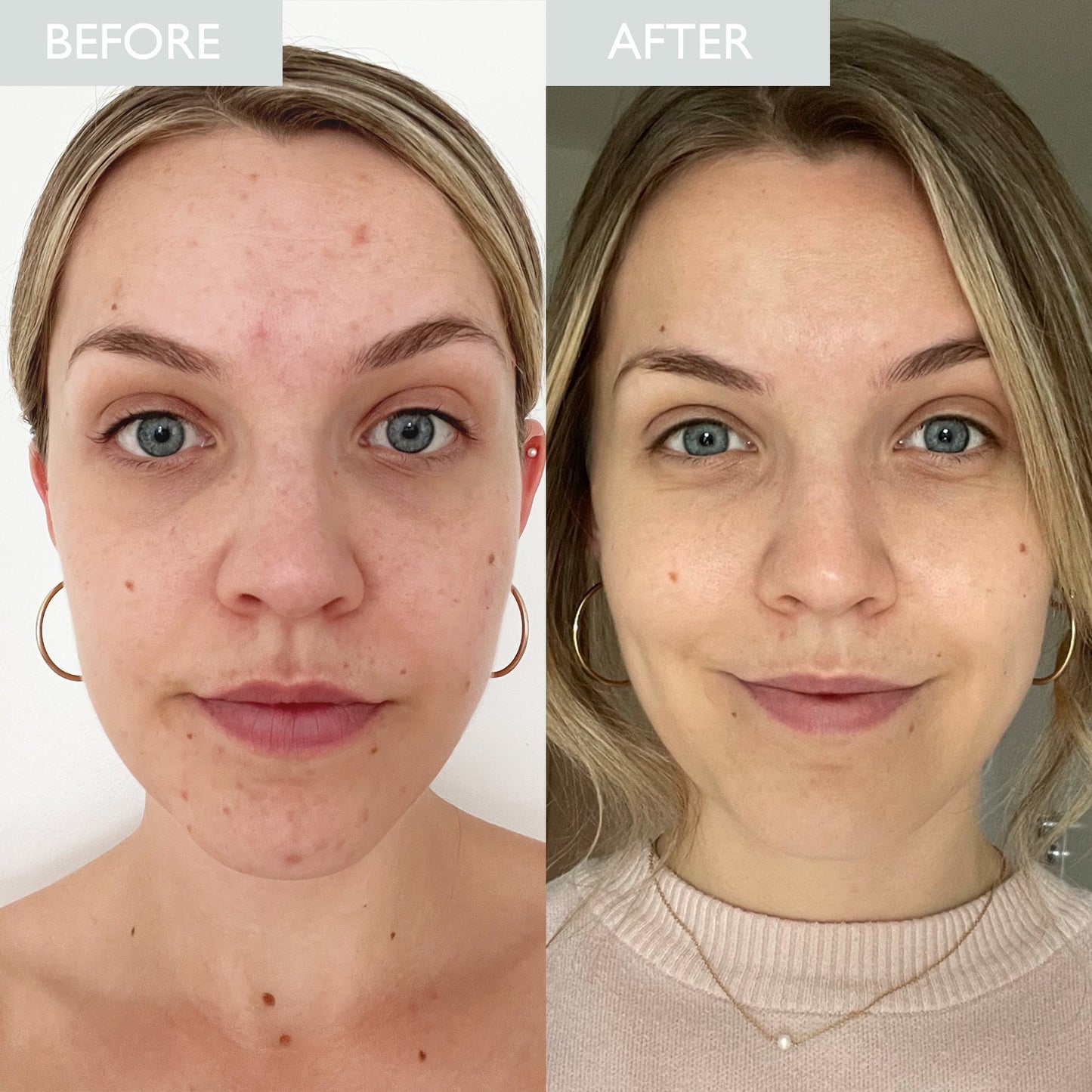 Image of a lady before and after using the combination skincare set.  Improved skin tone, texture and breakouts can be seen