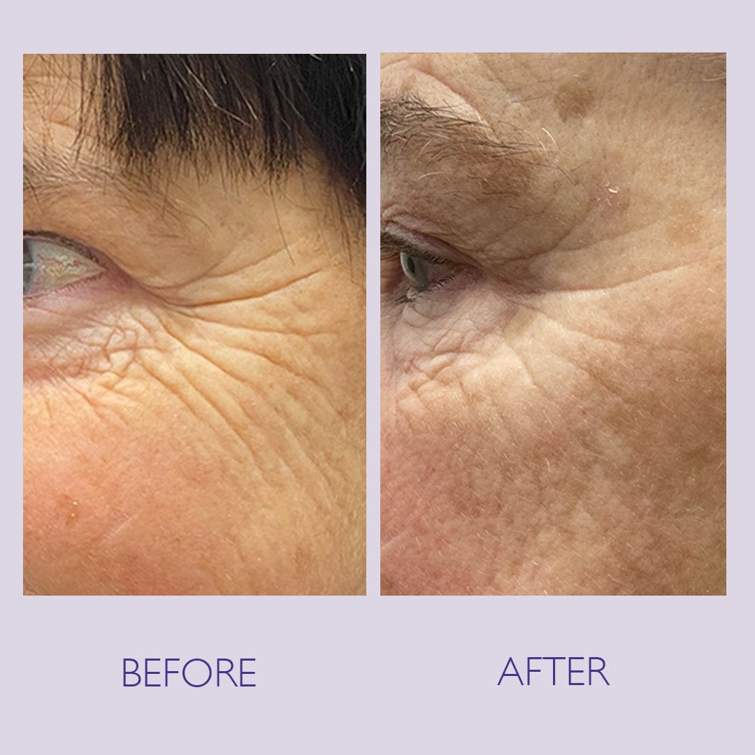 A before and after image showing a reduction in lines around the eye area with Skinician powerbalm level 1